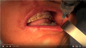 Video 1 